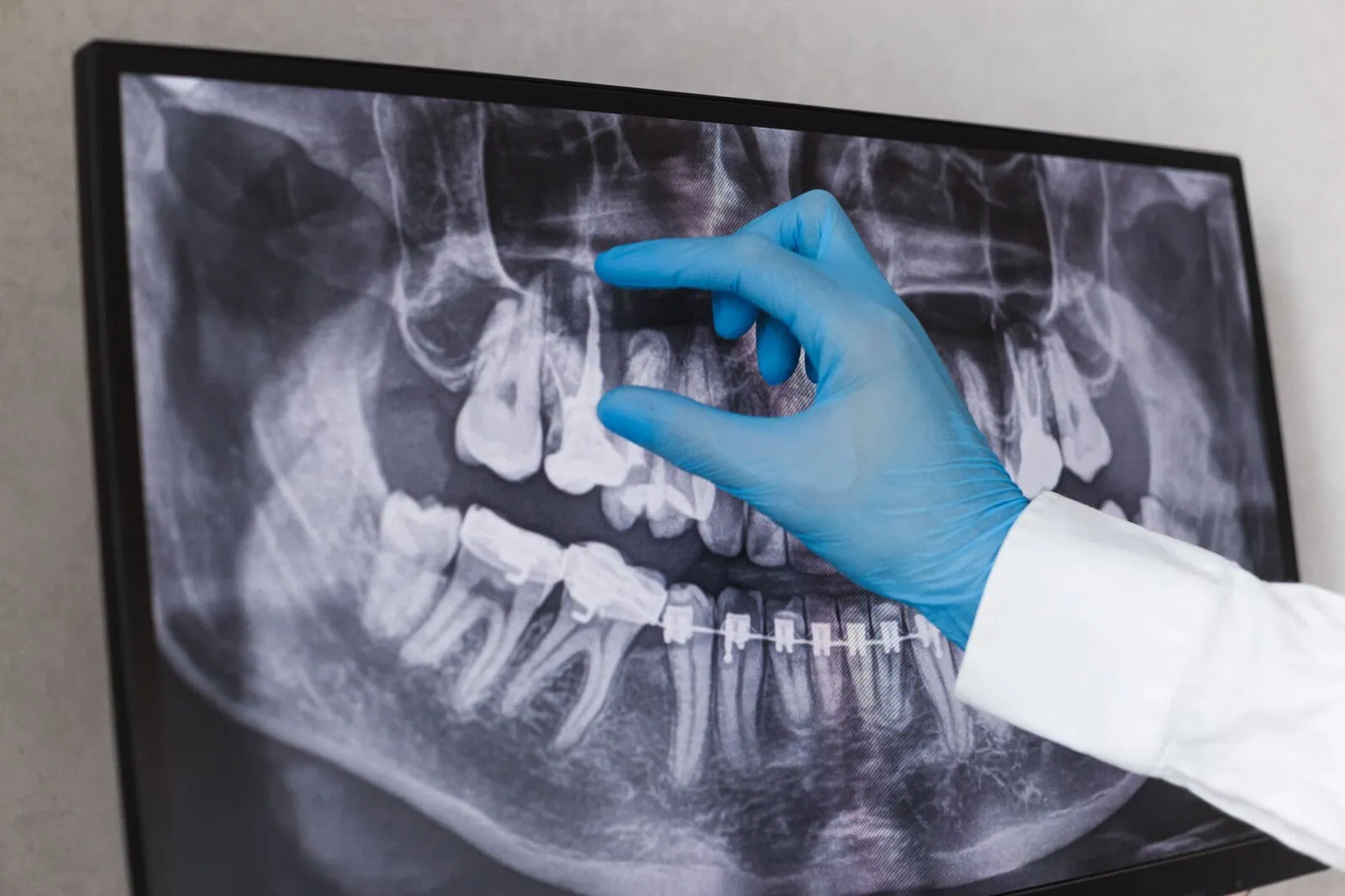 Modern root canal therapy at Peak Dental