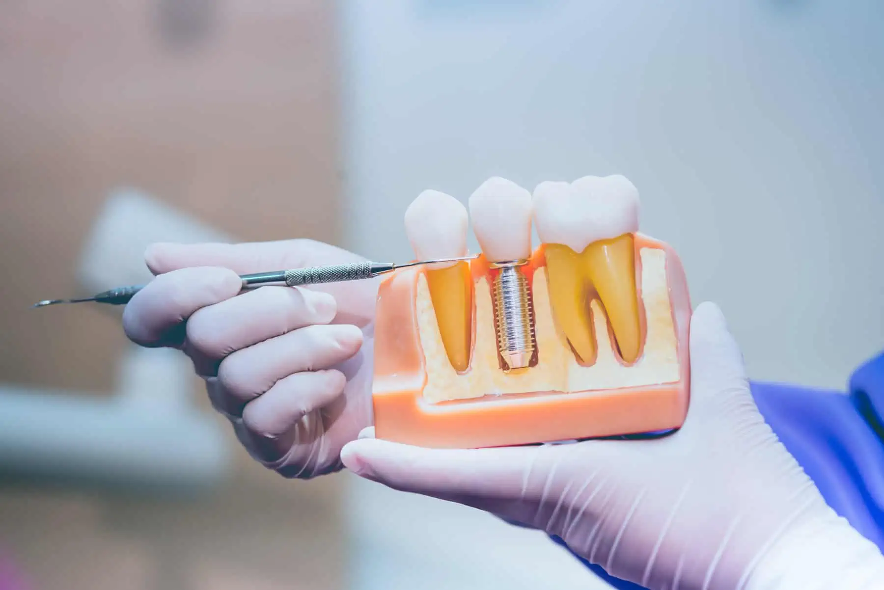 Dental implant placement after extraction