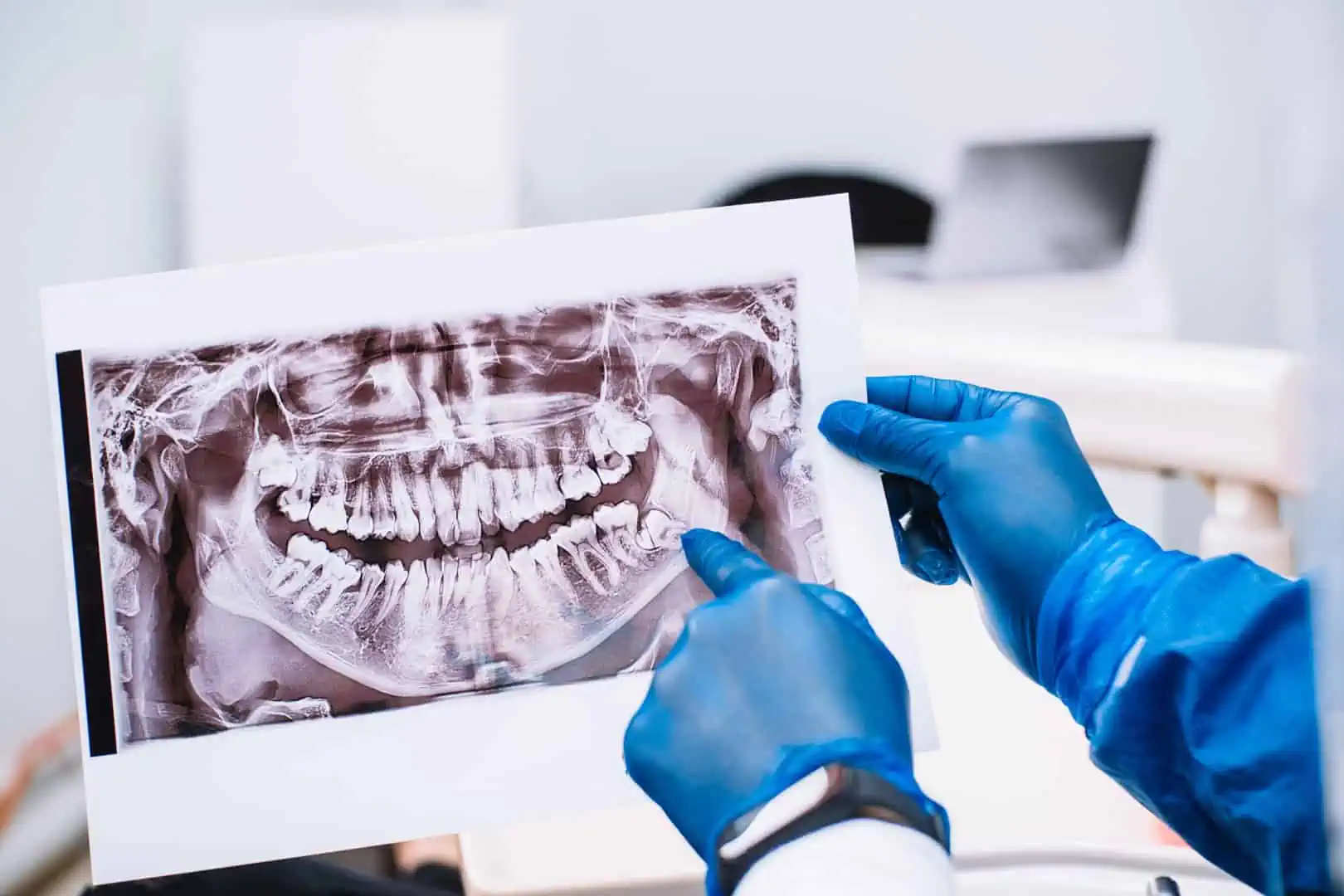Wisdom teeth removal procedure